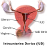 Blausen_0585_IUD